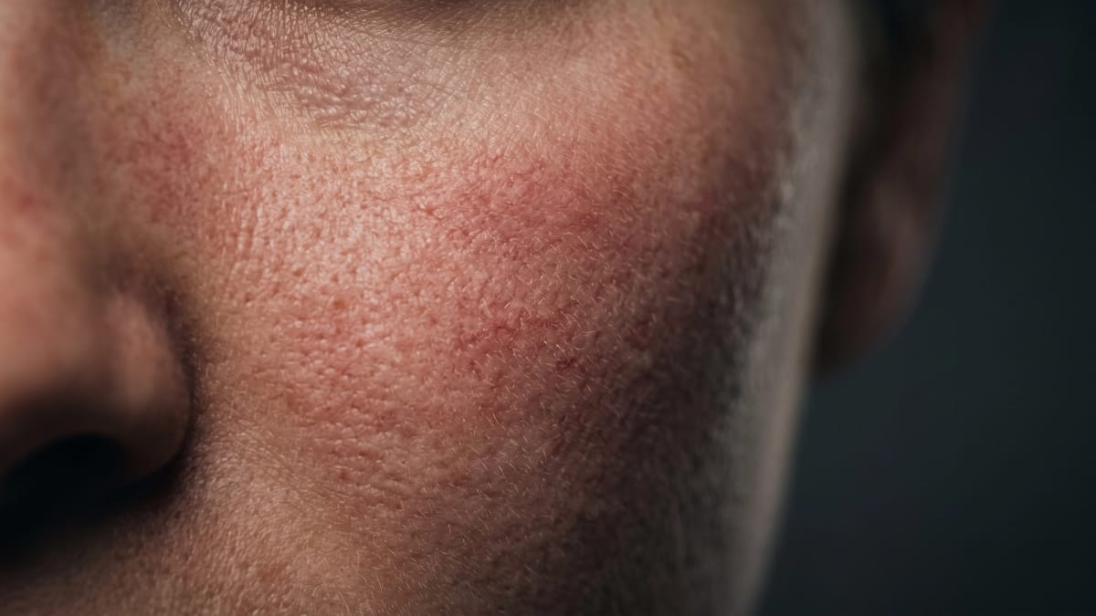 Розацеа: почему краснеет лицо и что реально помогает Основное изображение